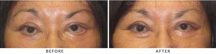 Ectropion and Entropion Before & After Photo -  - Patient 3