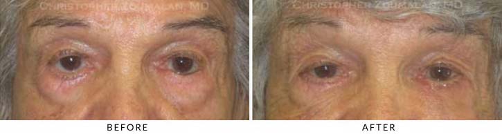 Ectropion and Entropion Before & After Photo -  - Patient 4