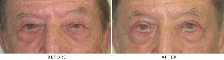 Ectropion and Entropion Before & After Photo -  - Patient 5