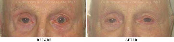Ectropion and Entropion Before & After Photo -  - Patient 6
