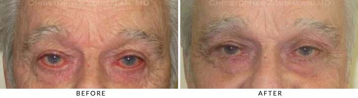 Ectropion and Entropion Before & After Photo -  - Patient 7