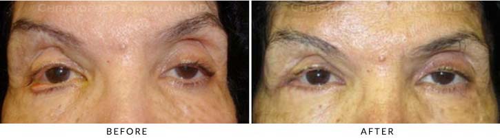 Ectropion and Entropion Before & After Photo -  - Patient 8