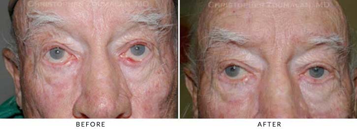 Ectropion and Entropion Before & After Photo -  - Patient 9