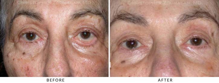 Ectropion and Entropion Before & After Photo -  - Patient 10