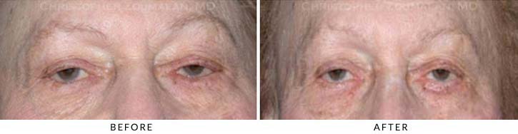 Ectropion and Entropion Before & After Photo -  - Patient 12