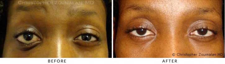 Ectropion and Entropion Before & After Photo -  - Patient 13