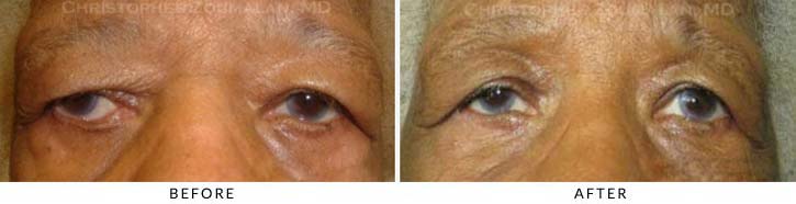 Ectropion and Entropion Before & After Photo -  - Patient 14