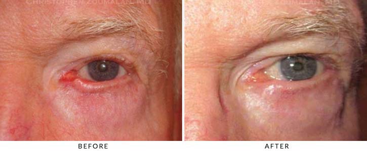 Ectropion and Entropion Before & After Photo -  - Patient 15
