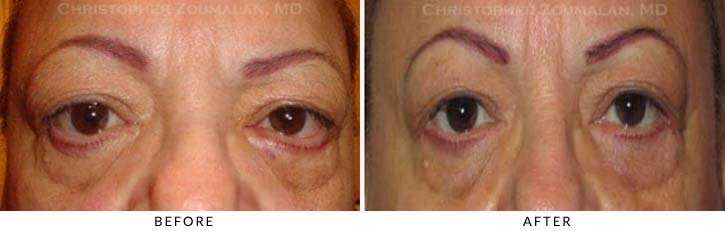 Ectropion and Entropion Before & After Photo -  - Patient 16