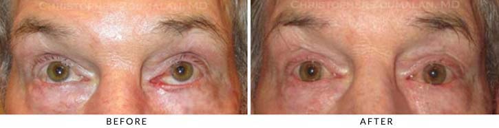 Ectropion and Entropion Before & After Photo -  - Patient 17