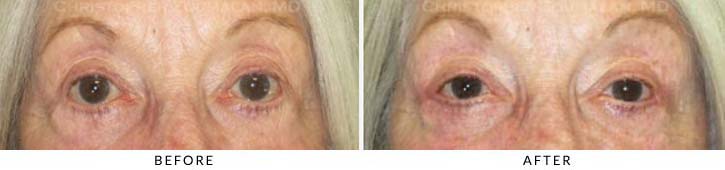 Ectropion and Entropion Before & After Photo -  - Patient 18