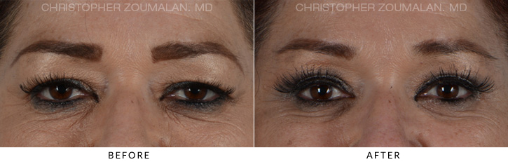 Endoscopic Brow Lift Before & After Photo - Patient Seeing Straight - Patient 12A