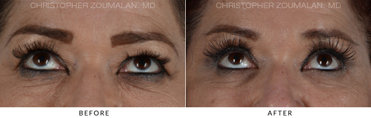 Endoscopic Brow Lift Before & After Photo - Patient Seeing Up - Patient 12B