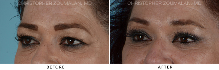 Endoscopic Brow Lift Before & After Photo - Patient Seeing Side - Patient 12C