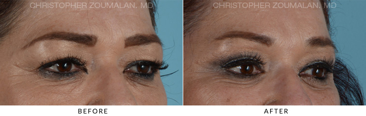 Endoscopic Brow Lift Before & After Photo - Patient Seeing Side - Patient 12D
