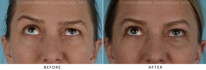 Endoscopic Brow Lift Before & After Photo - Patient Seeing Up - Patient 13B