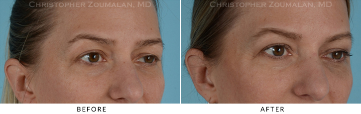 Endoscopic Brow Lift Before & After Photo - Patient Seeing Side - Patient 13C