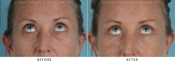 Endoscopic Brow Lift Before & After Photo - Patient Seeing Up - Patient 14B