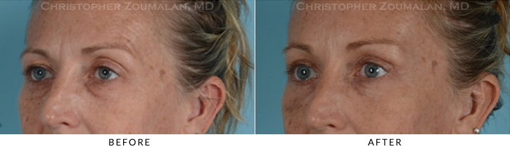 Endoscopic Brow Lift Before & After Photo - Patient Seeing Side - Patient 14C