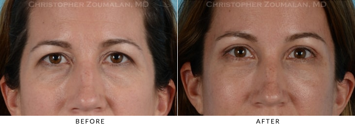 Endoscopic Brow Lift Before & After Photo - Patient Seeing Straight - Patient 15A