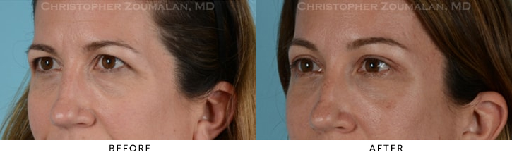 Endoscopic Brow Lift Before & After Photo - Patient Seeing Straight - Patient 15B