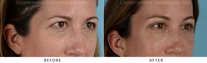 Endoscopic Brow Lift Before & After Photo - Patient Seeing Side - Patient 15C