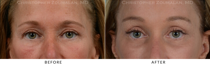 Endoscopic Brow Lift Before & After Photo - Patient Seeing Straight - Patient 13A