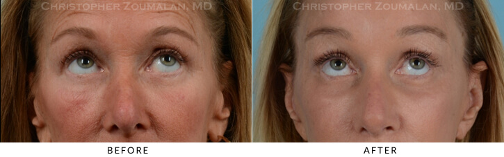 Endoscopic Brow Lift Before & After Photo - Patient Seeing Up - Patient 13B