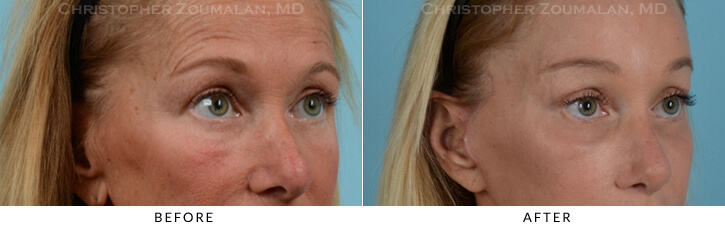 Endoscopic Brow Lift Before & After Photo - Patient Seeing Side - Patient 13C