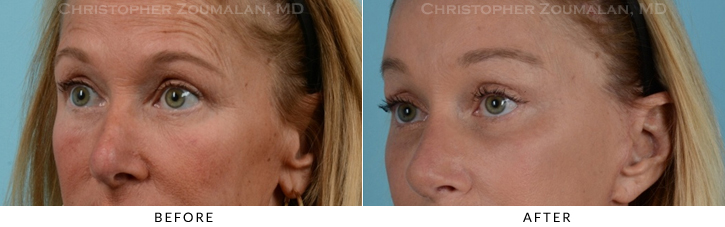 Endoscopic Brow Lift Before & After Photo - Patient Seeing Side - Patient 13D