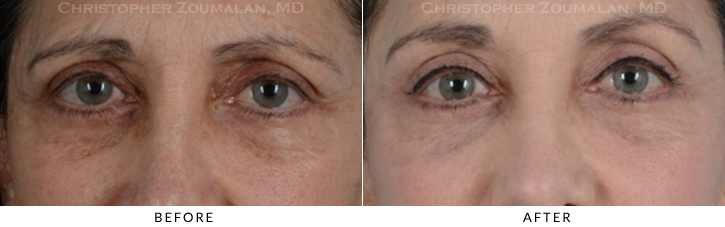 Endoscopic Brow Lift Before & After Photo - Patient Seeing Straight - Patient 14A