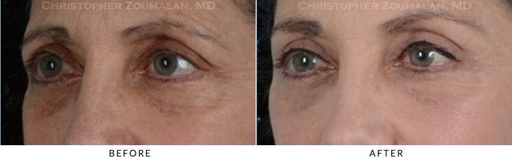 Endoscopic Brow Lift Before & After Photo - Patient Seeing Side - Patient 14B