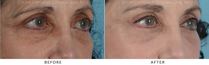 Endoscopic Brow Lift Before & After Photo - Patient Seeing Side - Patient 17C