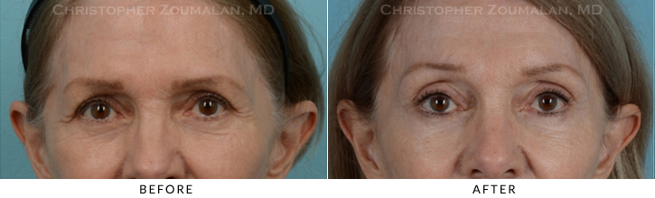 Endoscopic Brow Lift Before & After Photo - Patient Seeing Side - Patient 15A