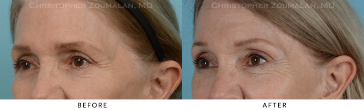 Endoscopic Brow Lift Before & After Photo - Patient Seeing Side - Patient 18B