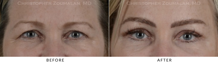 Endoscopic Brow Lift Before & After Photo - Patient Seeing Straight - Patient 16A