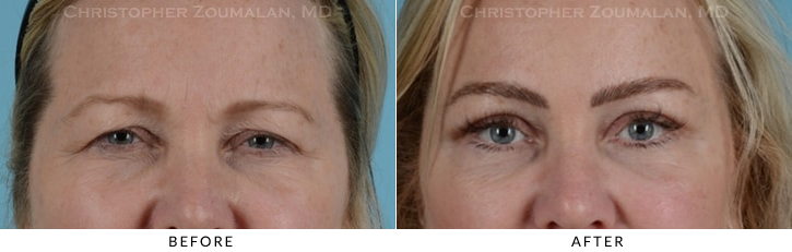 Endoscopic Brow Lift Before & After Photo - Patient Seeing Straight - Patient 19B