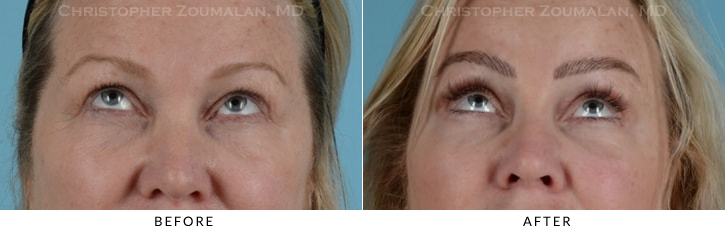 Endoscopic Brow Lift Before & After Photo - Patient Seeing Up - Patient 19C