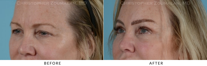 Endoscopic Brow Lift Before & After Photo - Patient Seeing Side - Patient 16D