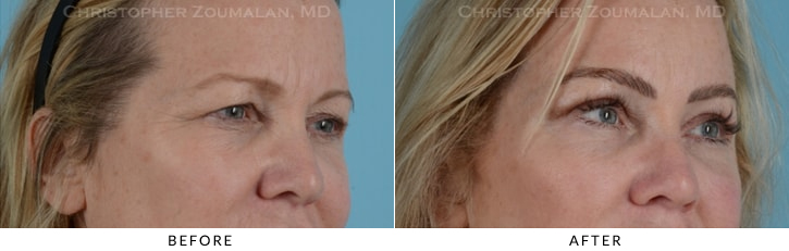Endoscopic Brow Lift Before & After Photo - Patient Seeing Side - Patient 16E