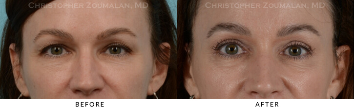 Endoscopic Brow Lift Before & After Photo -  - Patient 17