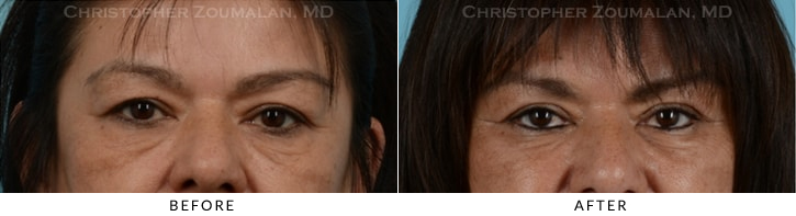 Endoscopic Brow Lift Before & After Photo - Patient Seeing Straight - Patient 18A