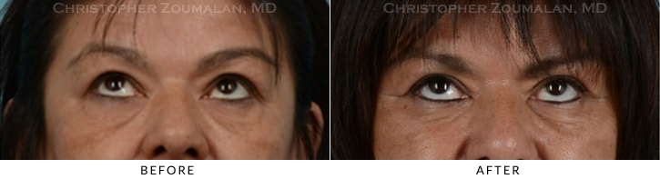 Endoscopic Brow Lift Before & After Photo - Patient Seeing Up - Patient 18B
