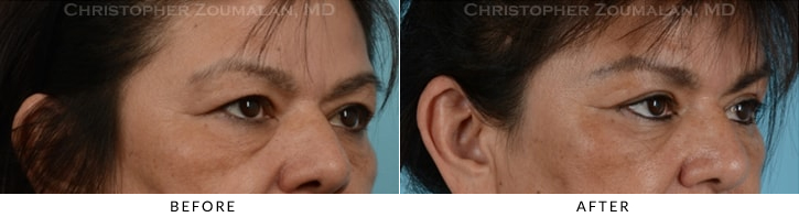 Endoscopic Brow Lift Before & After Photo - Patient Seeing Side - Patient 18C