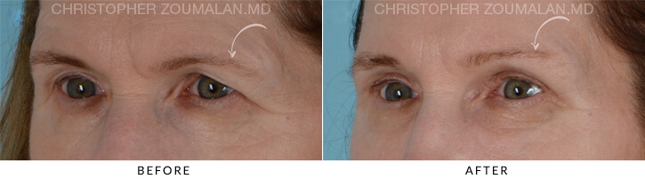 Endoscopic Brow Lift Before & After Photo - Patient Seeing Side - Patient 3B