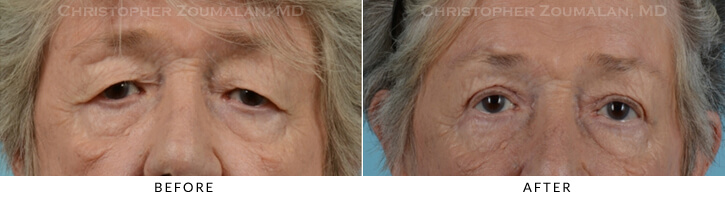 Endoscopic Brow Lift Before & After Photo - Patient Seeing Straight - Patient 22A