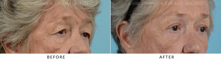 Endoscopic Brow Lift Before & After Photo - Patient Seeing Side - Patient 22B