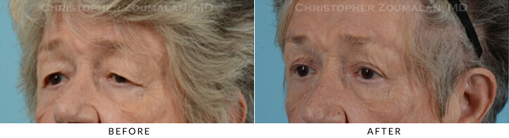 Endoscopic Brow Lift Before & After Photo - Patient Seeing Side - Patient 22C