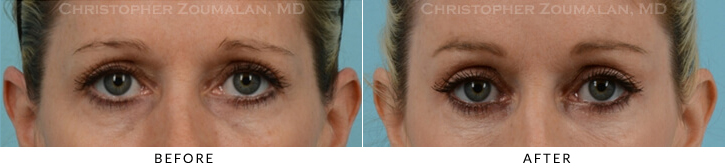 Endoscopic Brow Lift Before & After Photo - Patient Seeing Straight - Patient 23A