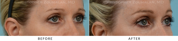 Endoscopic Brow Lift Before & After Photo - Patient Seeing Side - Patient 23B